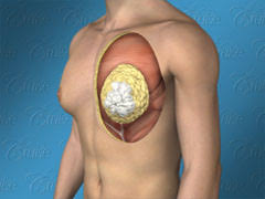 Gynecomastia