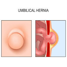 Umbilical Hernia
